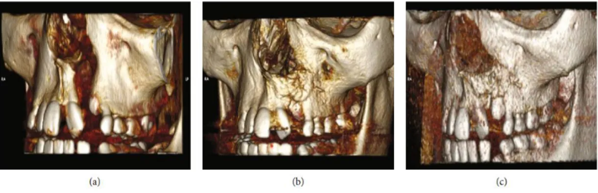 Figure 5: Computed tomography images of the same patient, showing the filling of the alveolar cleft by the bone  between 6 and 12 months after the use of bone tissue engineering procedures (DDPSC associated with Bio-Oss  Collagen®) and the rash of the cani