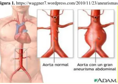 Figura 1. https://waggner7.wordpress.com/2010/11/23/aneurismas/ 