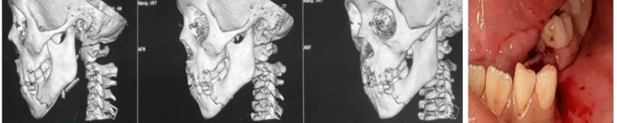 Figura 1: Exame de Imagem: tomografia em 3D e imagem intraoral dos fragmentos ósseos em mandíbula