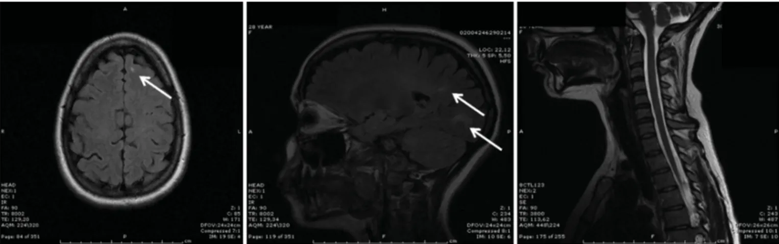 Figura 4. Imagens de RMN cerebral do Caso 2.