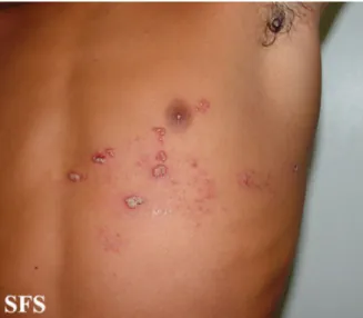 Figura 1. Lesão típica de herpes zoster, acometendo dermátomo em 