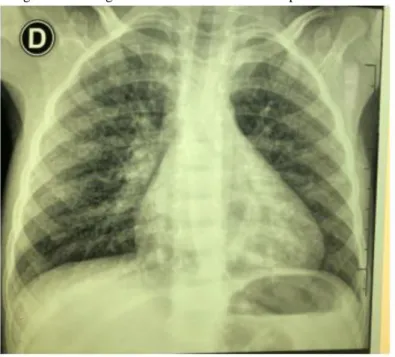 Figura 1- Radiografia de Tórax em incidência póstero-anterior 