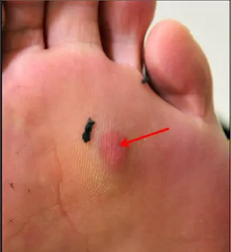 Figura 2: Nódulo eritematoso subcutâneo na sola do pé de paciente infectado por  Mycobacterium massiliense após acupuntura