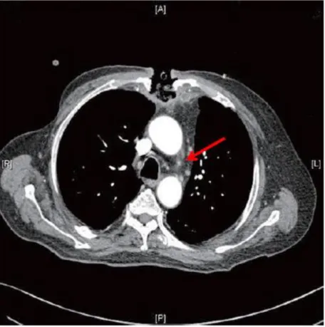 Figura 3 – Tomografia computadorizada (secção transversal) da região torácica de paciente  com infecção mediastínica por Gemella morbillorum