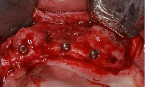 Figura  07:  Instalação  dos  implantes  dentários.  Note  incorporação  dos  blocos  ósseos e espessura óssea adequada para instalação dos implantes