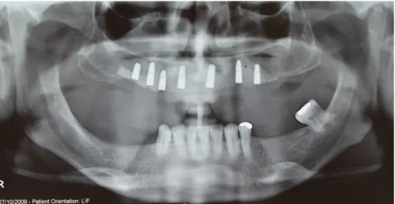Figura 08: Radiografia panorâmica mostrando os implantes dentários instalados. 