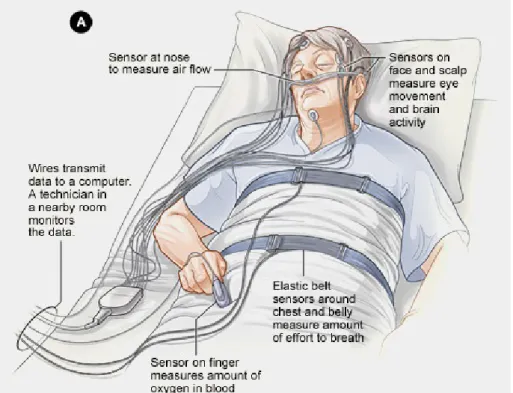Figure 5 .: Drawing representing a standard PSG montage on a patient [ 27 ].