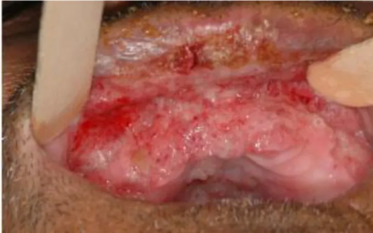 Figure 5. Chronic form of PCM. Ulcerative and infiltrative lesions with multiple hemorrhagic dots and crusts on the upper  gingiva and lip