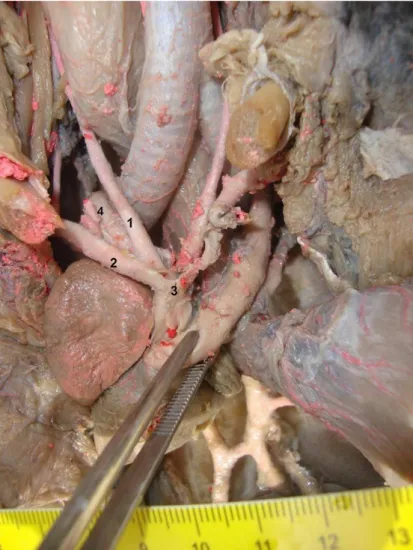 Figura 4: Artérias da base do coração: 1 - Artéria carótida comum  direita; 2 - Artéria subclávia direita; 3 - Tronco braquiocefálico; 4 -  Aorta direita