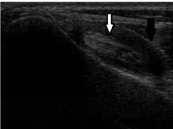 FIGURA 6:   Imagem ultrassonográfica, com transdutor de 12 MHz, plano transversal,  do tendão bíceps braquial do ombro esquerdo de cão portador de tenossinovite bicipital
