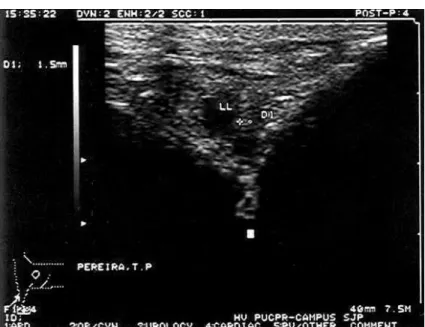 Figura 7 - Ultrassonografia da ATM esquerda de um equino em ponto transverso lateral. Observa-se linha  hiperecóica  em relação à  ecogenicidade do disco  intra-articular  gerada pela presença da  agulha medindo 