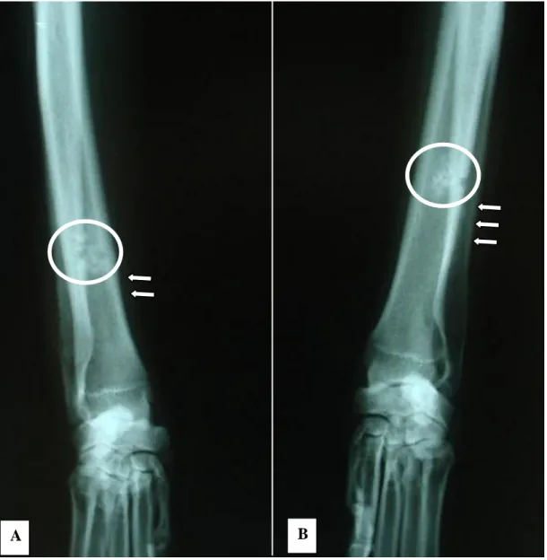 FIGURA 01: Imagem radiográfica em posição cranio-cauldal, ilustrando aumento  de  volume  de  tecidos  moles  adjacentes  (setas)  com  aumento  da  densidade  radiográfica  (círculo)  no  local  onde  foram  colocados  os  ossos  autógeno  (A)  e  xenógen