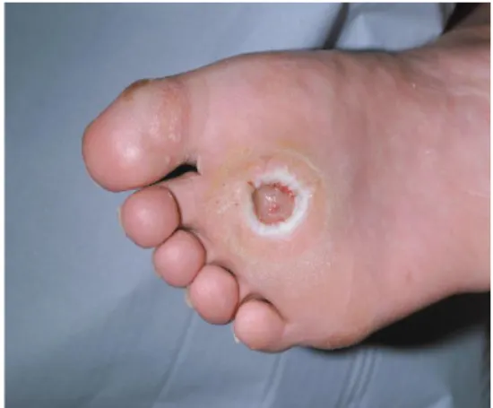 Figure  1.  Neuropathic  ulcer  in  a  typical  position,  i.e.  under  second  metatarsal  head  and  surrounded  by  callus (Taken from [6])