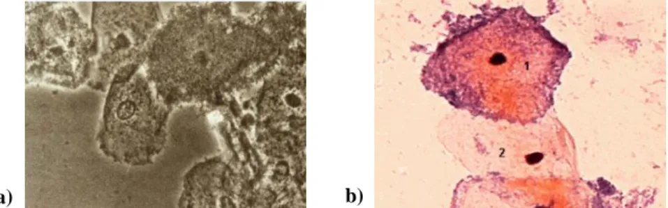 Figure 1.3. "Clue cells" in both images (original magnification, x400).  a) some cells have irregular edges  that define the "clue cells", those that do not have this characteristic are not "clue cells"; b) represents the  normal va
