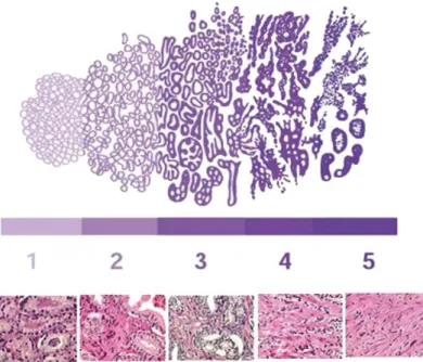 Figure 4. Gleason Score: histological grading for prostate cancer. Grade 1 (well differentiated): closely packed,  uniform shaped glands