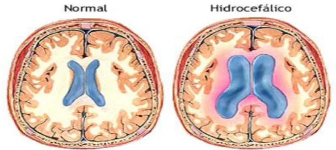 Figura 2 - Associação de Hidrocefalia e Mielomeningocele – AHME. Recuperado em 06.04.2014