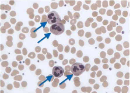FIGURE 1 Neutrophils are identifiable by their multi-lobulated nuclei and are indicated by arrows in this Giemsa- Giemsa-stained  blood  film