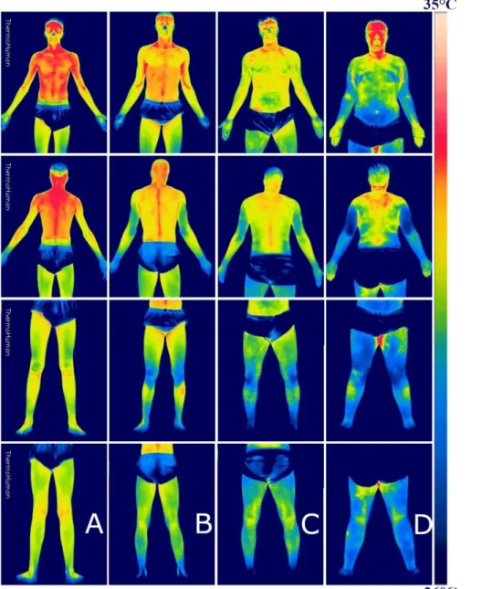 Figure 3: Thermograms of four representative participants of the study (n=100). Note: 