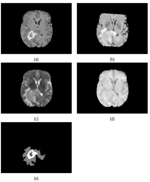Figura 2.6: Fatia de ressonância magnética, nas diferentes sequências disponibilizadas pela base de dados, para a realização de uma segmentação cerebral tumoral manual e o respetivo resultado (marcação manual).