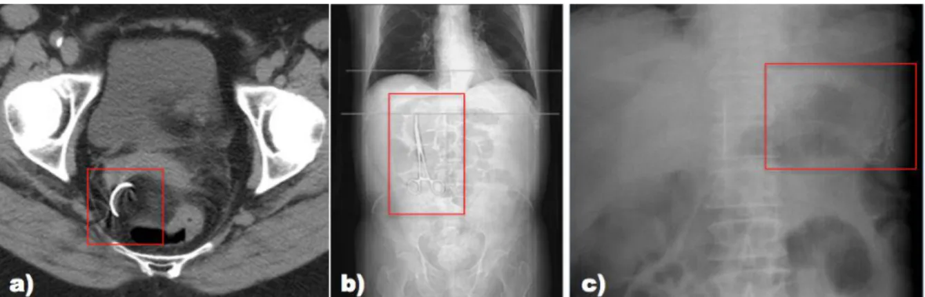 Figure 1 – Different foreign bodies retained during surgery: a) Retained needle detected by a CT scan to the  pelvis; b) Retained clamp detected by an abdominal radiograph; c) Retained opaque sponge detected by 