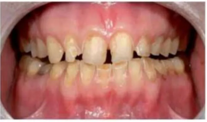 Figure 2.12 -  Erosion caused by refrigerant and attrition caused by bruxism [27] 