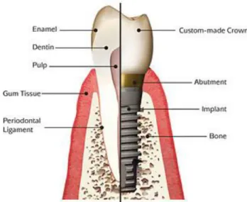 Figure 2.13 - Difference of the constitution of natural and artificial tooth 4   
