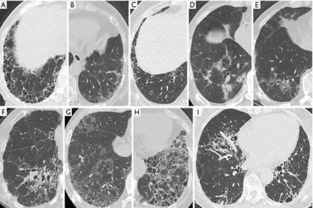 Figura 4: Imagens de tomografia computadorizada demonstrando os padrões de  doença pulmonar intersticial (YAMAKAWA et al., 2019)