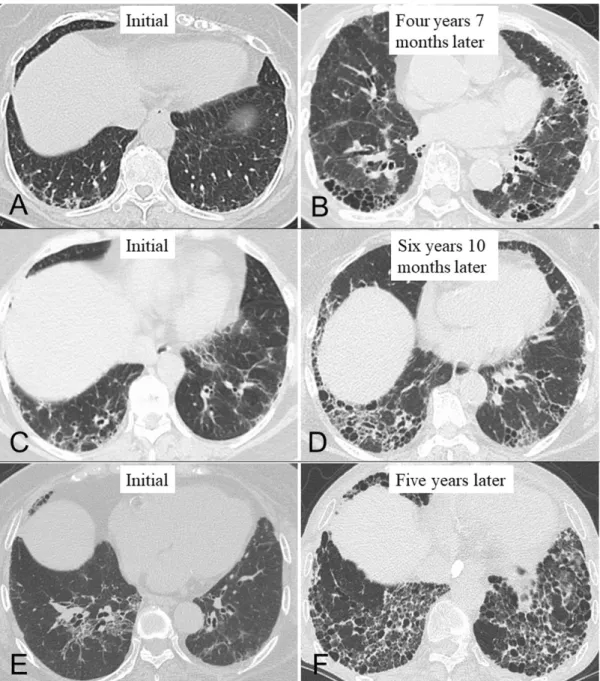 Figura 5: Imagens tomográficas do padrão de “favo de mel” em pacientes com AR. 