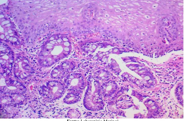 Figura  4:  Corte  histológico  de  esôfago  corado  com  hematoxilina-eosina,  evidenciando  metaplasia  esofágica  (EB),  objetiva de 200x.