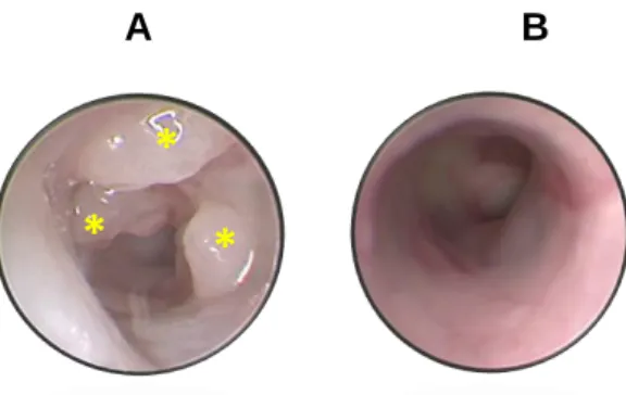Figure 8 - Colonoscopy images of a Lrig1Cre/;Apcfl/+ mouse on day 50 after  tamoxifen induction