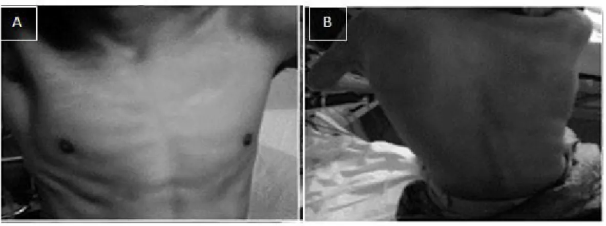 Figure 3: Patient’s images. A: Intercostal drawing and malnutrition. B: Severe scoliosis