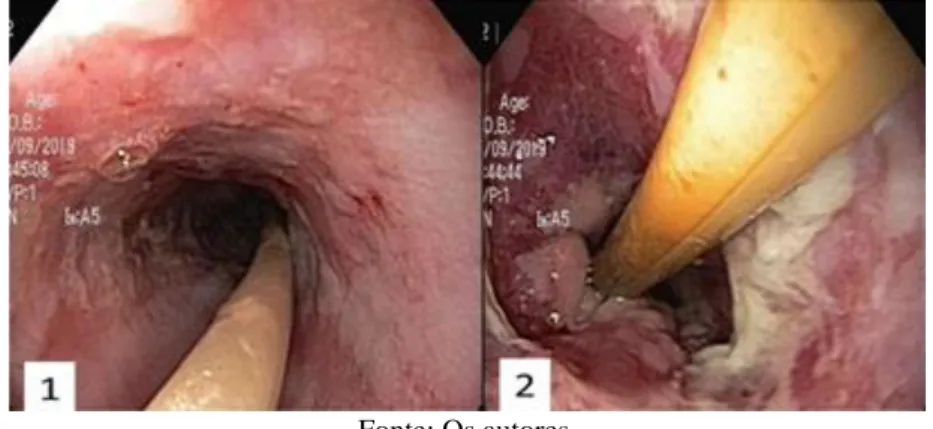 Figura  02:  1.  Esôfago  médio  com  mucosa  friável,  com  erosões  recobertas  por  hematina  e  envoltas  por  retrações  cicatriciais brancas e presença de sonda nasoenteral (SNE); 2