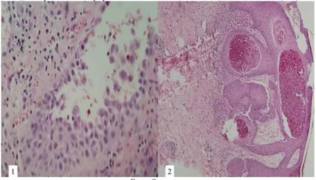 Figura 3.1: Histopatológico de pele revela epiderme com acantólise suprabasal em meio a eosinófilos (Hematoxilina- (Hematoxilina-eosina, x100); 3.2: Epiderme exibe hiperplasia e microabscessos de eosinófilos (Hematoxilina-(Hematoxilina-eosina, x40)