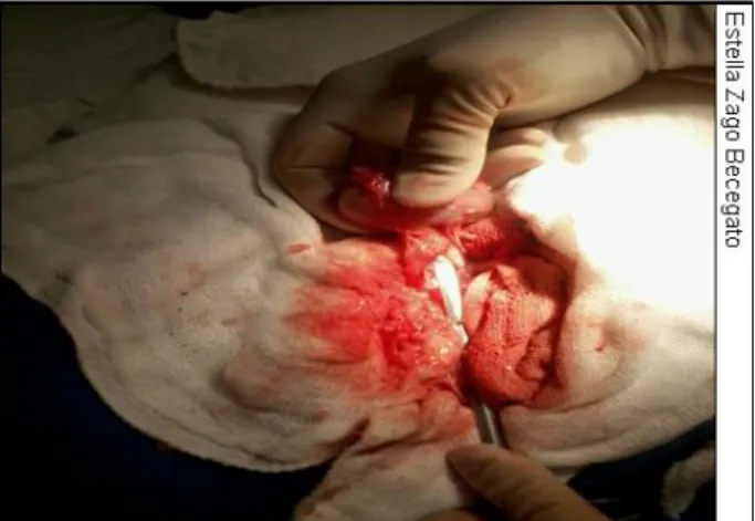 Figura  4  –Aspecto  do  rim  direito  durante  procedimento  de  nefrectomia  unilateral,  mostrando dilatação da porção proximal do ureter 