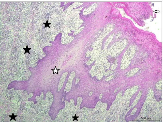 Figura 3 - Bovino. Balanite. Há hiperplasia pseudocarcinomatosa acentuada da camada  espinhosa  (estrela  branca)  associada  a  crostas  serocelulares  superficiais  (seta)  e  infiltrado  inflamatório  multifocal  acentuado  de  linfócitos,  eosinófilos 