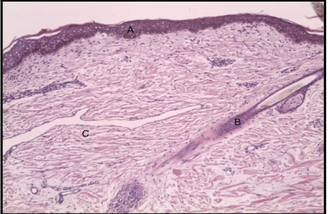 Figura 3- Corte histológico do feto acárdio amorfo holocárdio do caso 01. Observa-se o  tecido epitelial (A), a formação de um folículo piloso (B) e grande quantidade de tecido  conjuntivo fibroso (C)