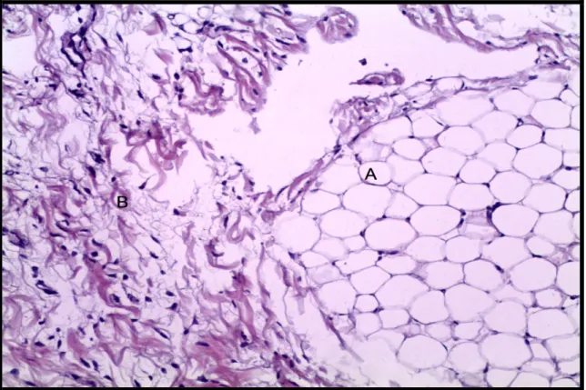 Figura 4- Corte histológico do feto acárdio amorfo holocárdio do caso 02. Observa-se a  presença de um grupo de adipócitos (A) e tecido conjuntivo fibroso abundante (B)
