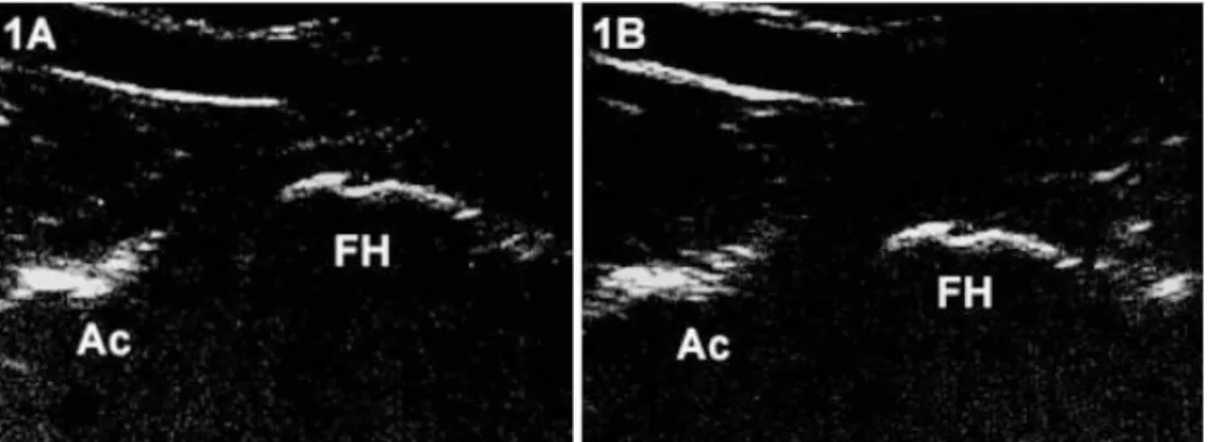 Figura  6:  Imagens  ultrassonográficas  longitudinais  da  articulação  coxofemoral  direita  em  um  plano  oblíquo  caudomedial–craniolateral:  (A)  sem  estresse  e  (B)  posição  em  distração; Ac = borda acetabular craniolateral,  FH = cabeça femoral