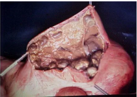 Figura 4. Imagem fotográfica de Metrite puerperal aguda com  retenção de placenta. 