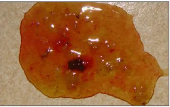 Figura 6. Foto de diarreia causada por Giardia 