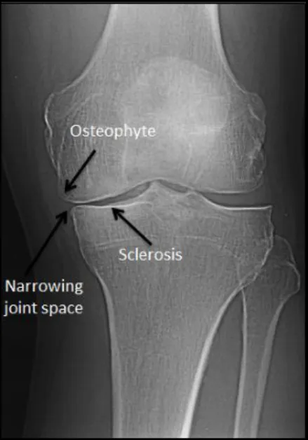 Figure 3 – Radiograph  of a knee joint from a  patient suffering from knee  osteoarthritis
