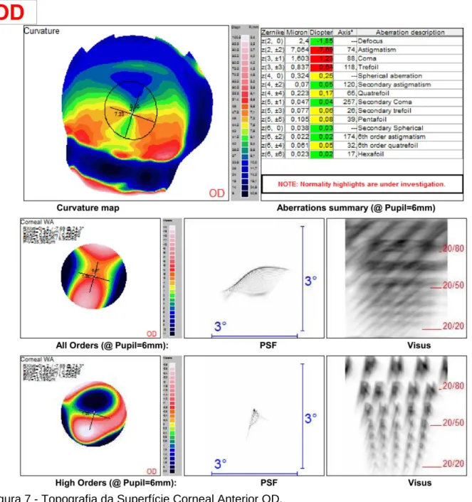 Figura 7 - Topografia da Superfície Corneal Anterior OD. 