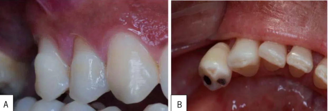 Figura 12- Fenómenos tribológicos em ambiente oral classificados de acordo com a literatura dentária: A-  abrasão, B- Atrito e erosão [30] 
