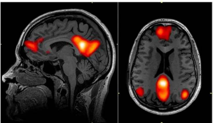 Figure 5 –The Default Mode Network includes areas in the medial pre-frontal cortex, precuneus,  and bilateral parietal cortex
