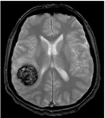 Figura 16. Imagem de uma hemorragia interna cerebral utilizando o contraste T2*. Adaptado de  (UBM Medica Network, 2014) 
