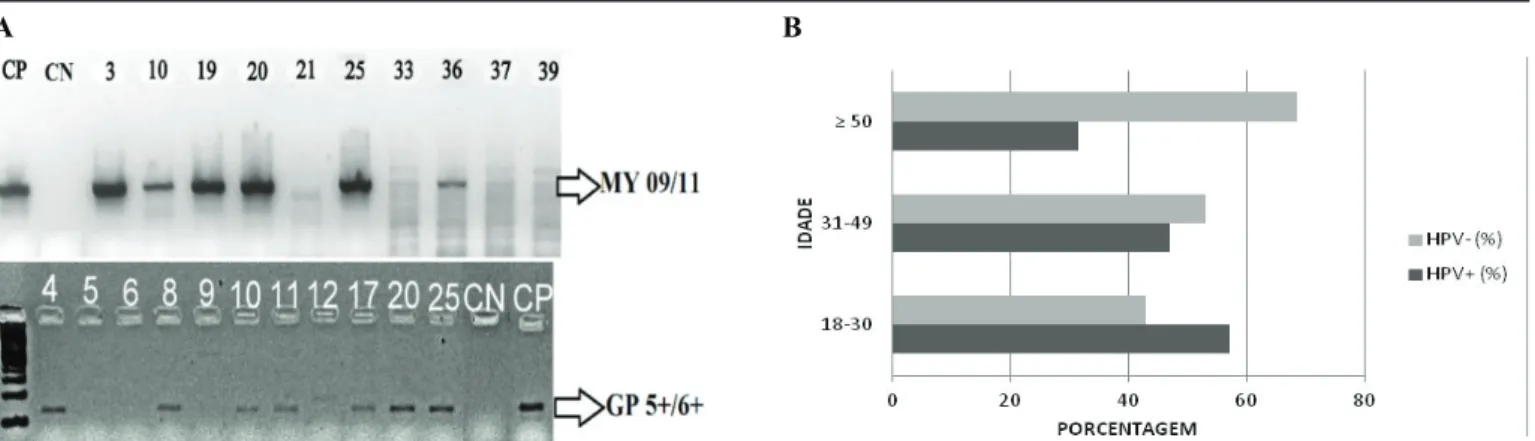 Figura 2. Reação de PCR para detecção de DNA de HPV em amostras cervicovaginais. A) Reação de PCR seguida de corrida  eletroforética em gel de agarose a 2% inspecionado a luz ultravioleta