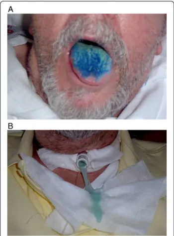 Figure 1 Methylene blue swallowing assessment. A. Oral administration of methylene blue