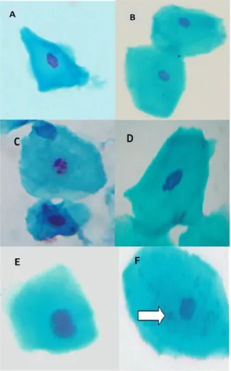 Figure 1 - Photomicrograph of exfoliated buccal mucosa cells: A)  Normal basal cell; B) Normal differentiated cell; C) Karyorrhexic  cell; D) Cell with Nuclear Bud (NB); E) Binucleated cell (BN); F) 