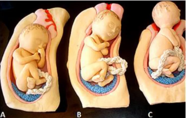 Figura 3. Modelos feitos em biscuit do processo de trabalho de parto. Em A, observamos o início da  perda  do  tampão  mucoso