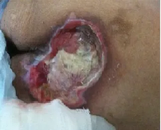 Figura  1.  Úlcera  de  pressão  na  região  sacral  antes  do  início  do tratamento